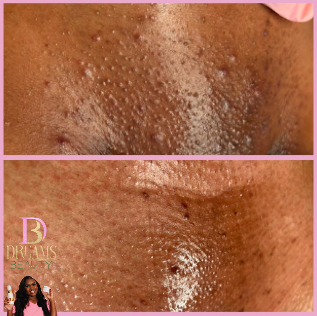 ByeBye Bump Exfoliating Pads