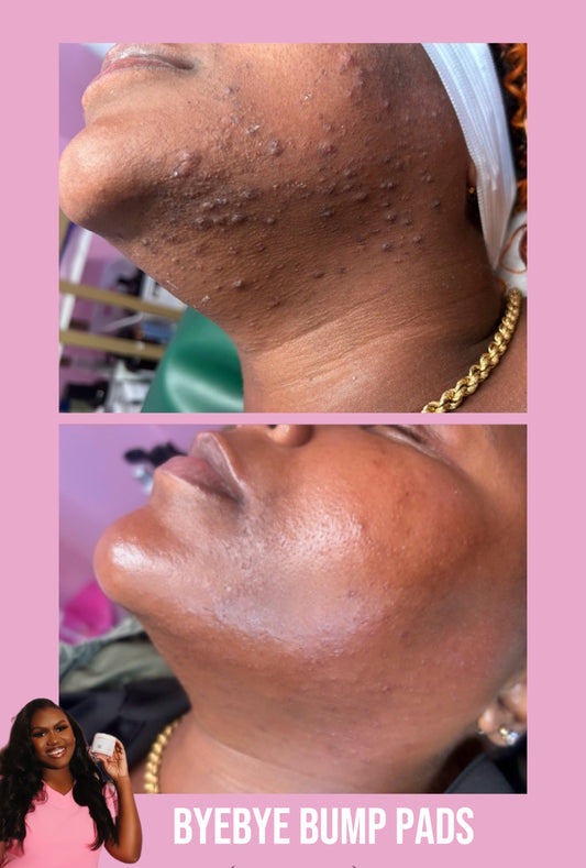ByeBye Bump Exfoliating Pads