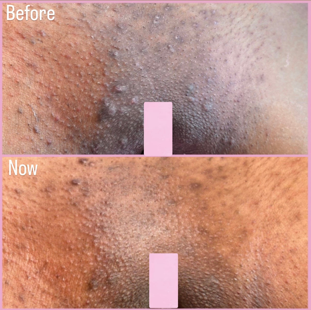 ByeBye Bump Exfoliating Pads